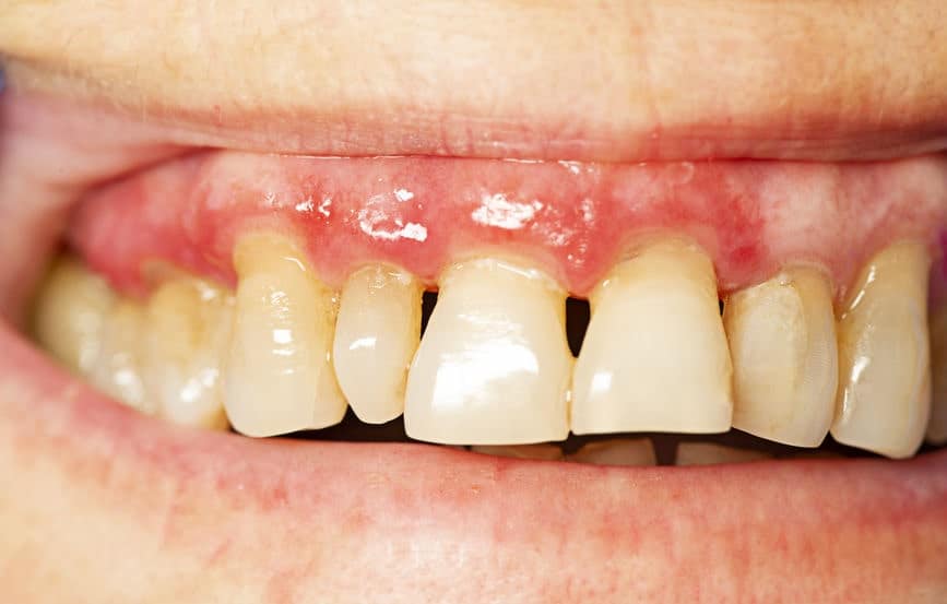 traitement parodontite - dr gallese - dentiste (2)